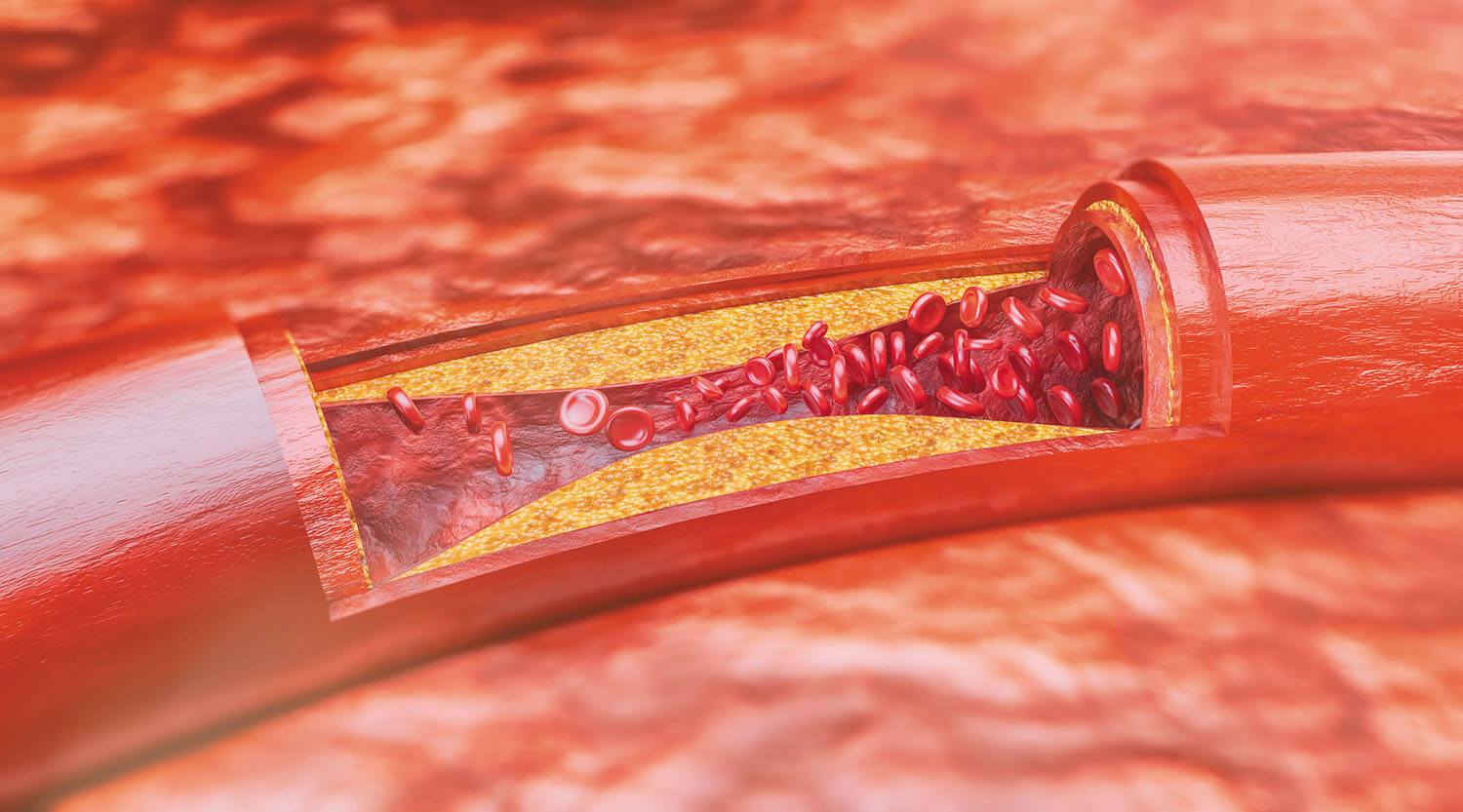 Plaque Artery