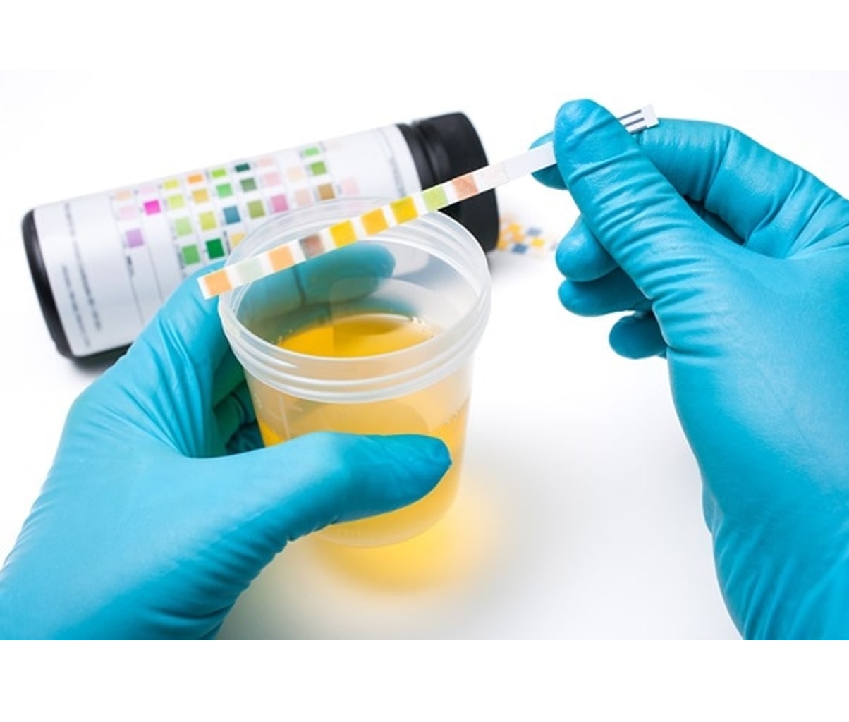 Urine Analysis | آزمایشگاه وحید