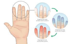 پدیده رینود - کاهش جریان خون در انگشتان